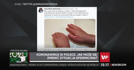 Koronawirus. Posłanka pokazała poranione ręce córki. Czy dzieci muszą używać płynu do dezynfekcji? Lekarz wyjaśnia wątpliwości