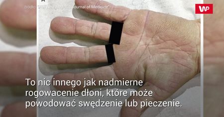 Bolały ją dłonie. Diagnoza była poważniejsza, niż ktokolwiek się spodziewał