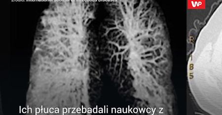 Co koronawirus robi z płucami.  Wstrząsające zdjęcia włoskich lekarzy
