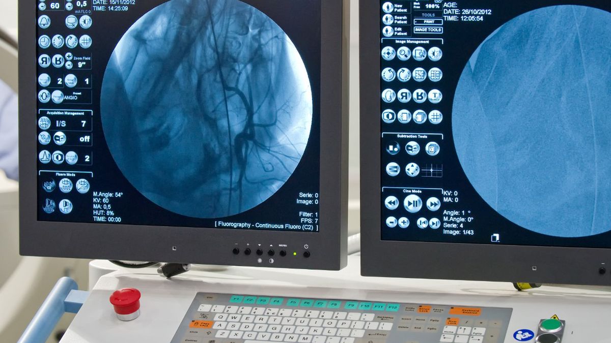 Angiografia mózgowa jest badaniem wykonywanym przy podejrzeniu tętniaka lub malformacji naczyniowej.