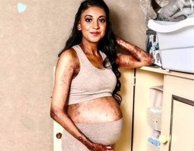 35-letnia mama cierpi na rzadką chorobę genetyczną. "Codziennie muszę owijać się bandażami jak mumia"