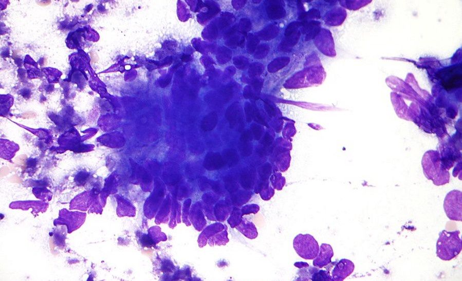 Umierające komórki nowotworowe przekazują innym instrukcje, jak przetrwać chemioterapię