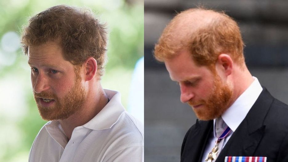 Książę Harry za dwa lata zostanie łysy?