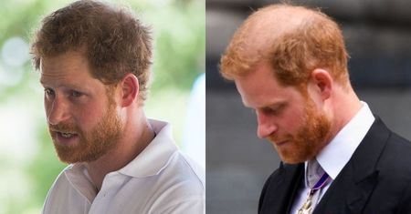 Chirurg przyjrzał się włosom księcia Harry'ego. Nie ma dobrych wieści