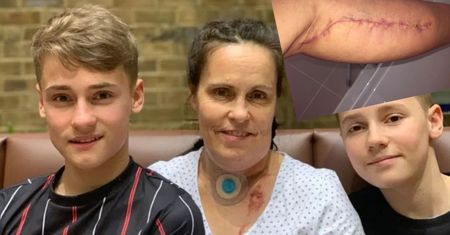 48-letniej mamie chorej na raka zrekonstruowano język za pomocą mięśnia łydki
