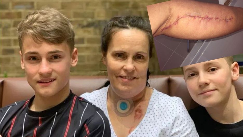 48-letniej mamie chorej na raka zrekonstruowano język za pomocą mięśnia łydki