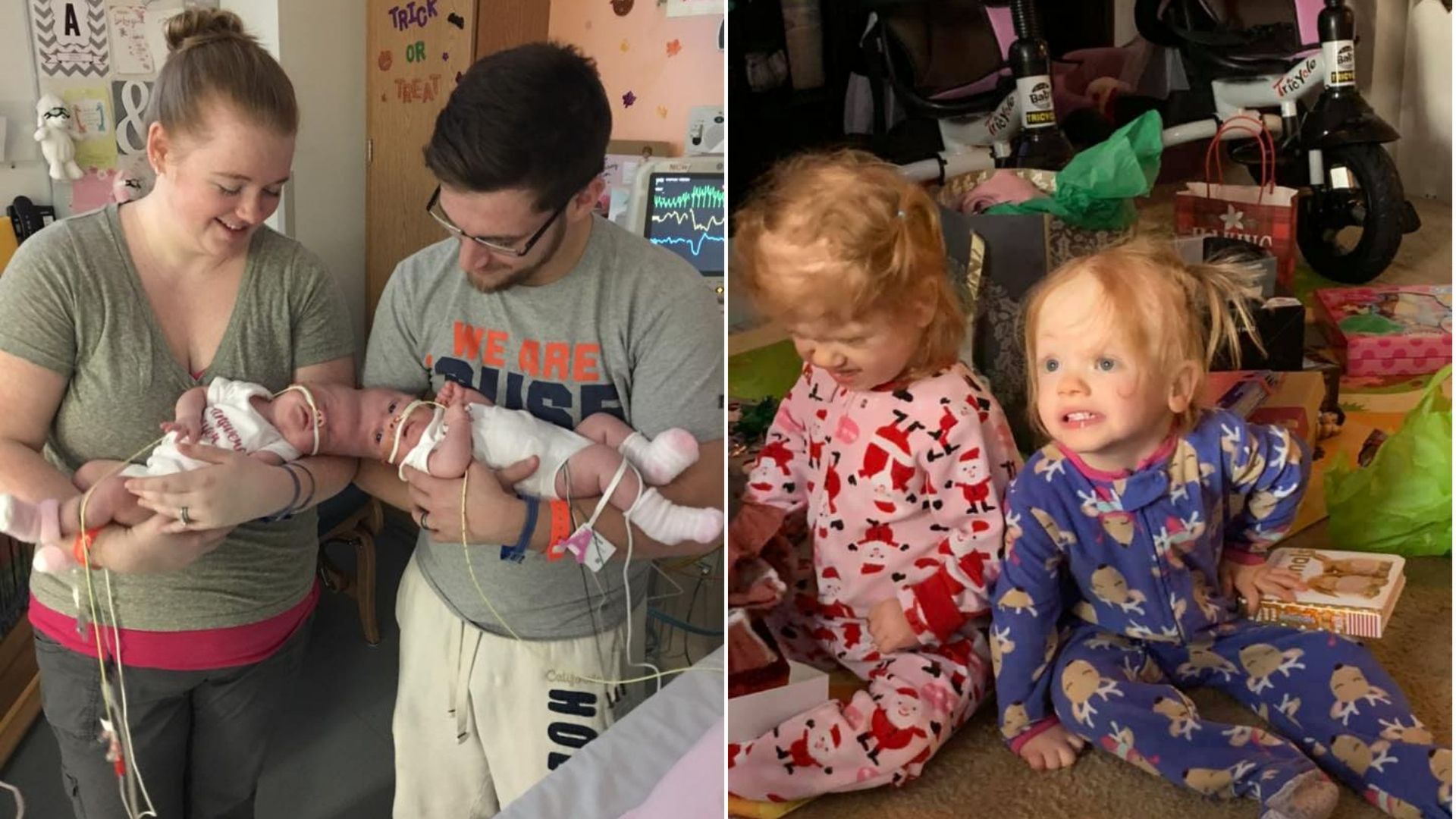 Bliźniaczki są jednymi z najmłodszych dzieci, które przeszły operację rozdzielenia