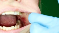 Nadżerka w jamie ustnej - przyczyny, objawy i leczenie