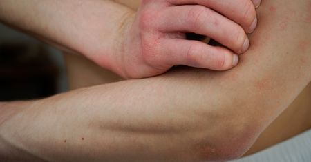 Co na uczulenie? Jak radzić sobie z uczuleniem i objawami alergii