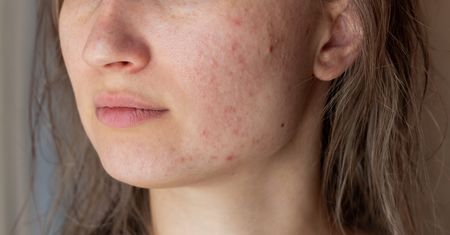 Niepokojący urodowy "hit". Dermatolożka bije na alarm