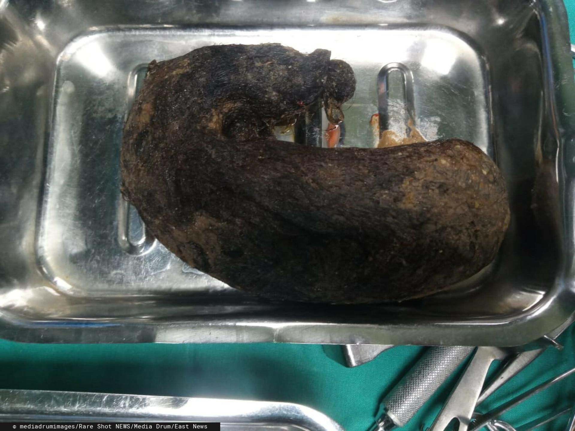 Włosy znalezione w żołądku 