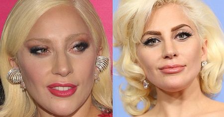 "Lady Gaga przesadziła z botoksem i wypełniaczami" (FOTO)