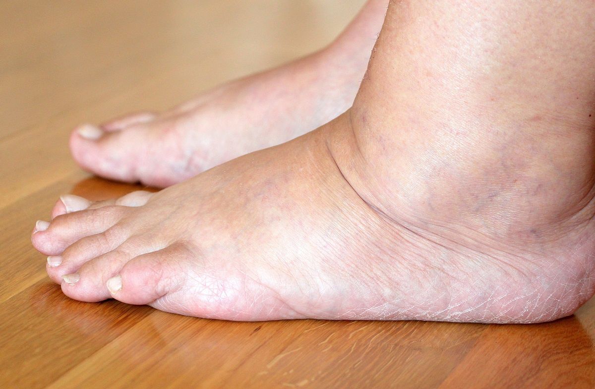 Say goodbye to swollen feet with daily vinegar soaks