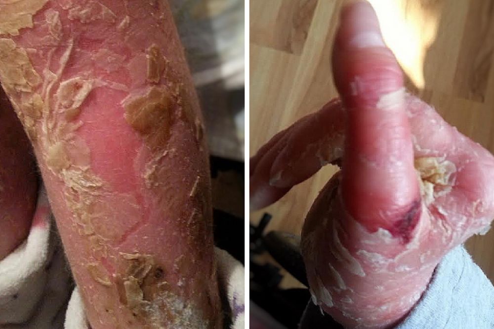 Skóra Julii jest cienka jak bibuła