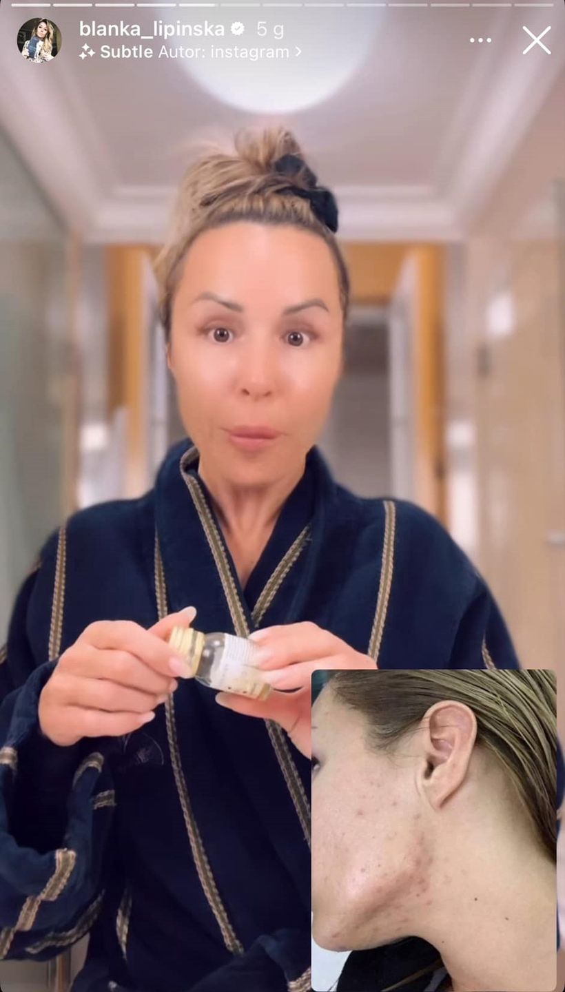 Blanka Lipińska walczyła z trądzikiem 