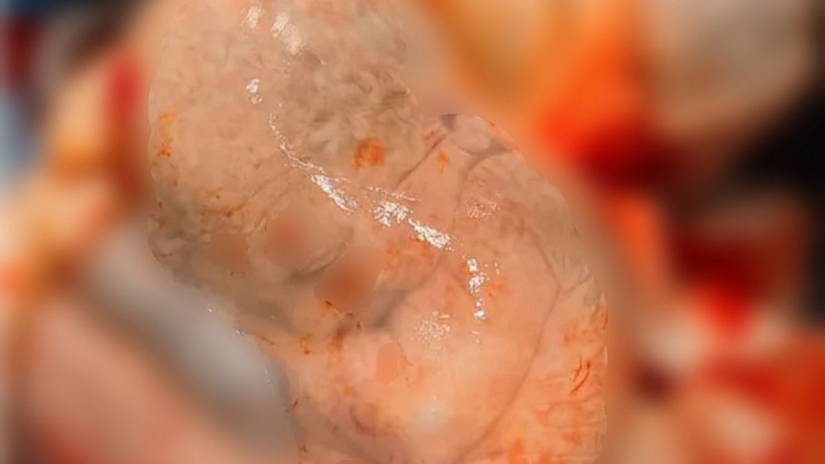 Wcześniak w pęcherzu.