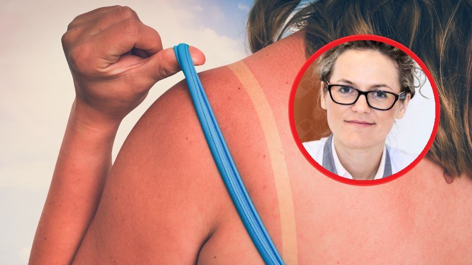 Opalasz się na czerwono? Narażasz skórę na bardzo poważną chorobę