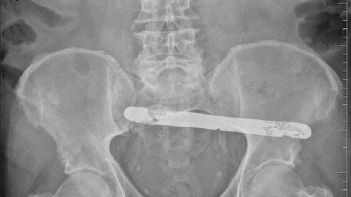 Mężczyzna żył ze szpatułką w ciele