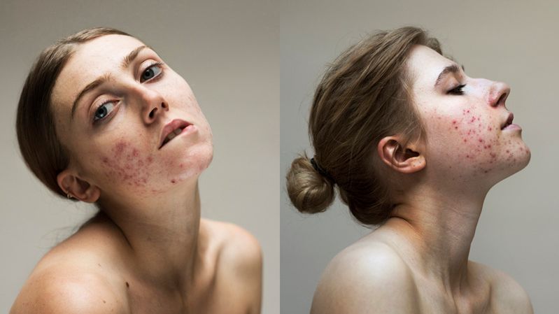 Problemy skórne to nie wstyd. Te kobiety mają dużo odwagi 1