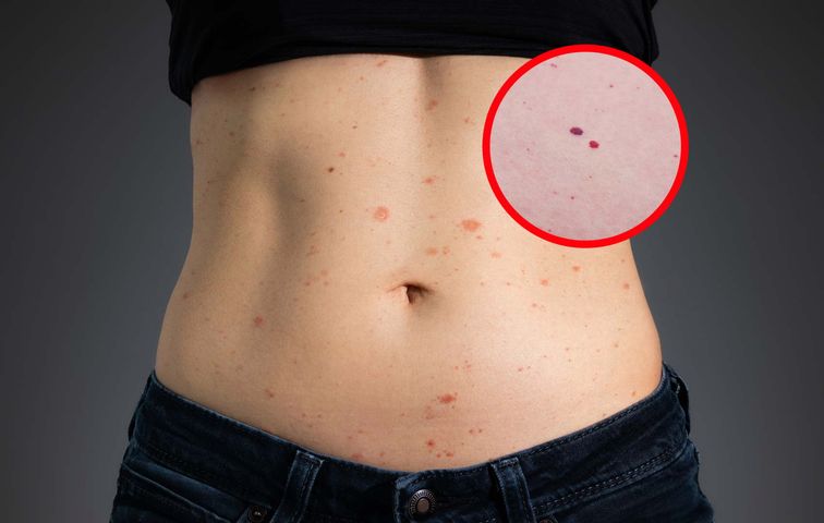 Wysyp czerwonych kropek na ciele? Tak organizm może ostrzegać cię o chorobie