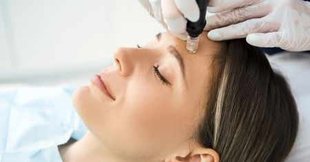 Mezoterapia igłowa — na czym polega i kto powinien się zdecydować?