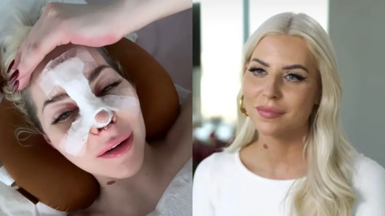 Julia von Stein pochwaliła się efektem po operacji nosa