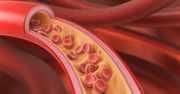 Hipercholesterolemia na talerzu: Co naprawdę zmienia dietę?