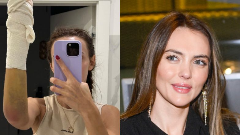 Marcela Leszczak złamała rękę w 4 miejscach