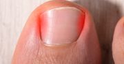 Prosty trik na wrastający paznokieć