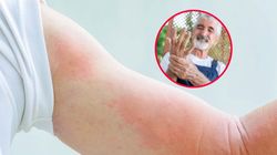 Atakuje kolejna choroba zakaźna. Latem ryzyko zakażenia rośnie