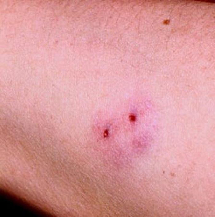 Ukąszenie żmii [http://nextews.com/73d91164/]