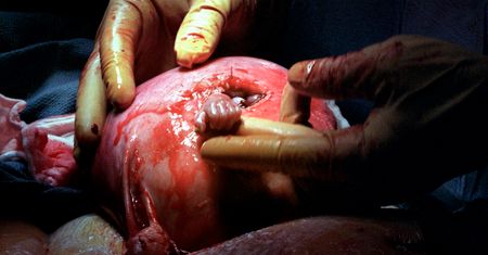 ''Hand of Hope''. Dziecko ze słynnego zdjęcia ma już 22 lata
