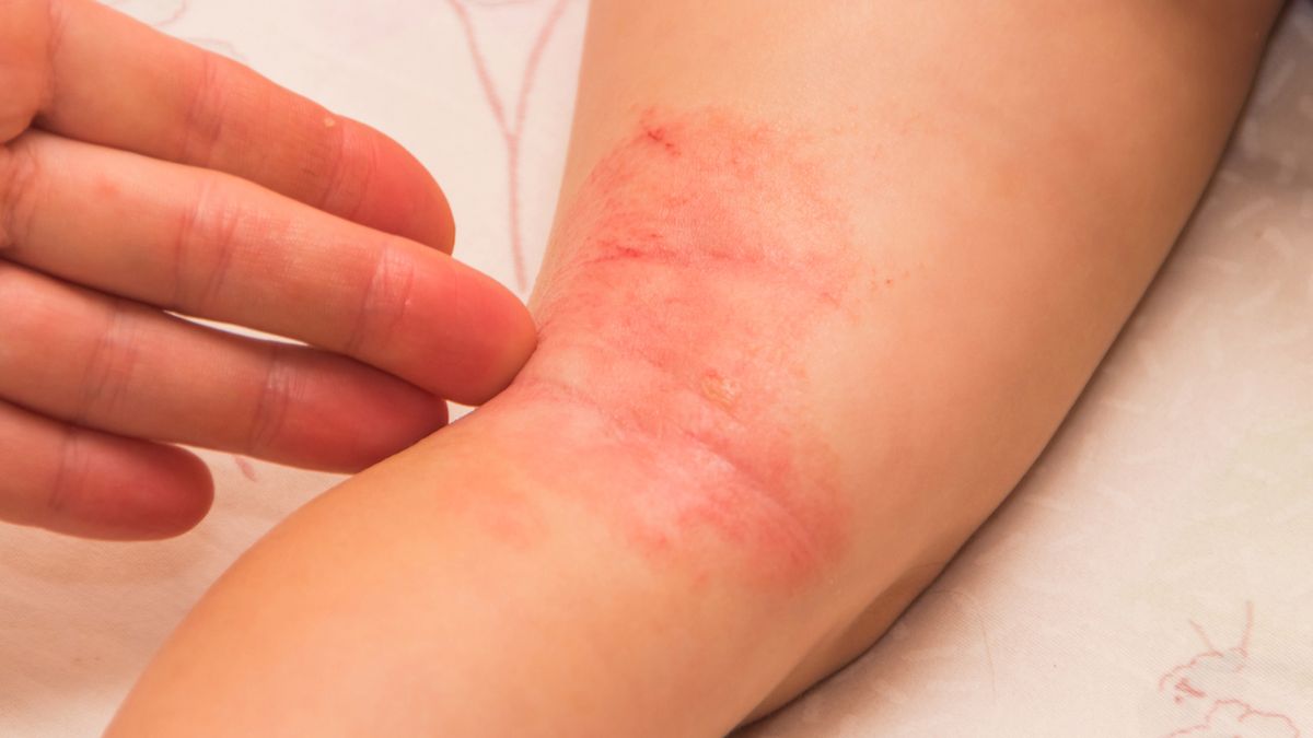 U dzieci z grzybicą znacznie częściej rozwiją się reakcje alergiczne.