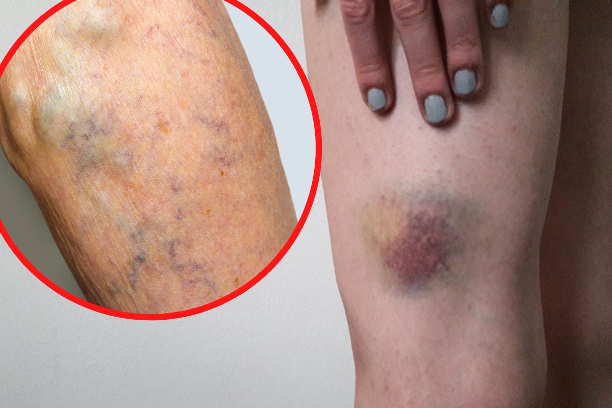 Nieleczone są poważnym zagrożeniem. Jak rozpoznać zakrzep krwi i czy można go odróżnić od siniaka?