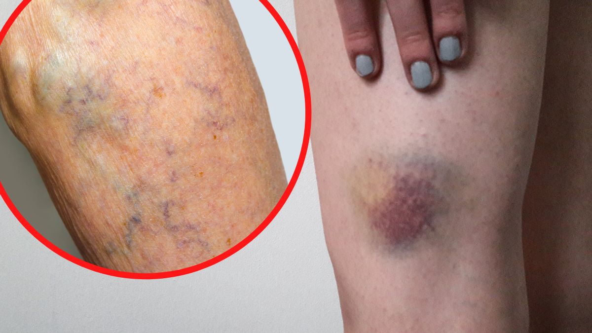 Czy można odróżnić zakrzep od siniaka?