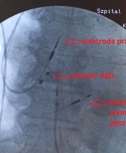Wrocław. Nowatorska stymulacja serca w szpitalu im. T. Marciniaka. Niewielu ją wykonuje