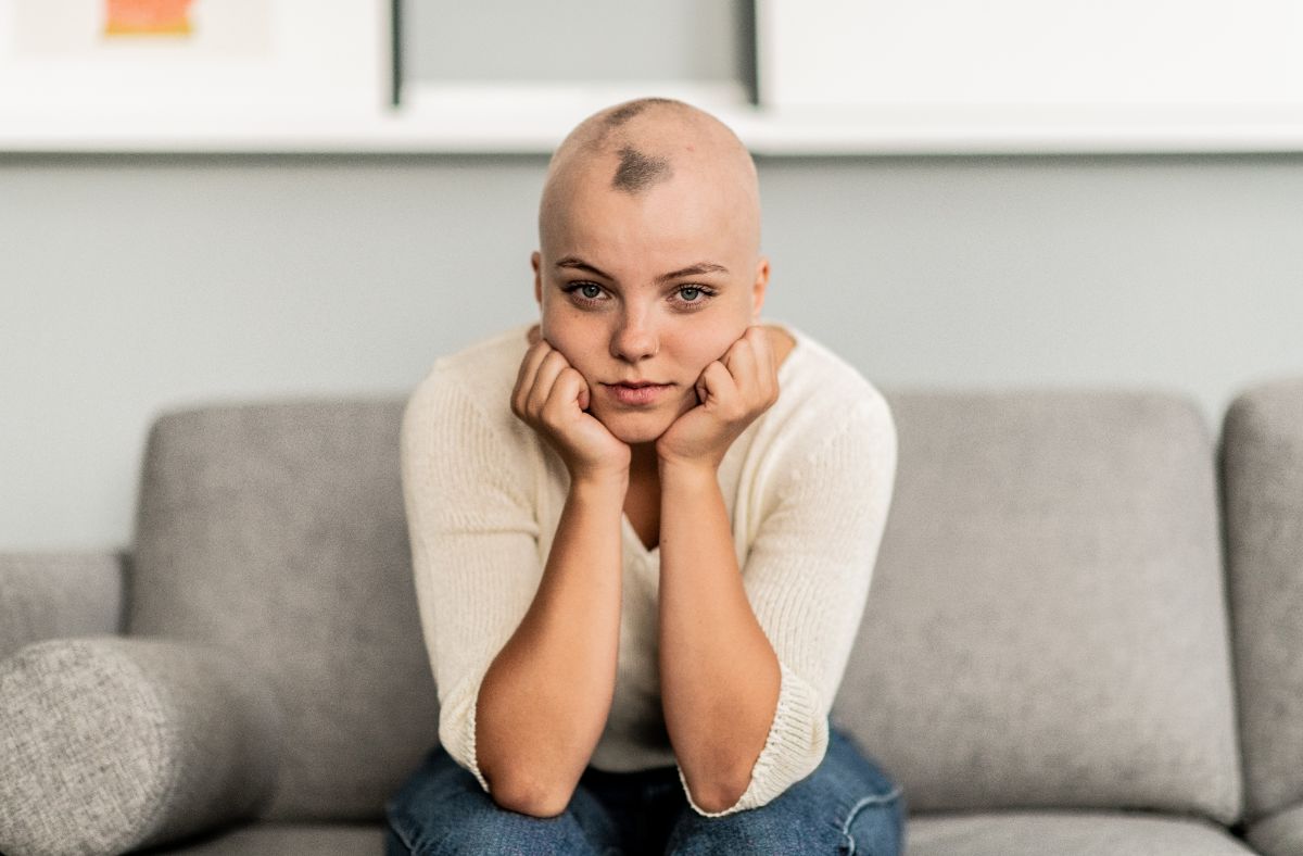 A woman suffering from alopecia areata