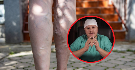 Lekarz zdradza pięć objawów objawów zakrzepicy. Pojawiają się u 50 proc. pacjentów