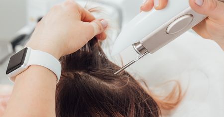 Laser frakcyjny a łysienie plackowate – zastosowanie i efekty