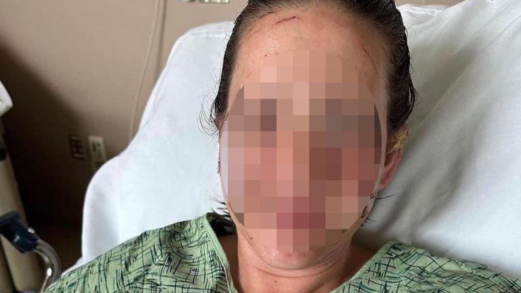 Kobieta pokazała twarz po ataku wydry 