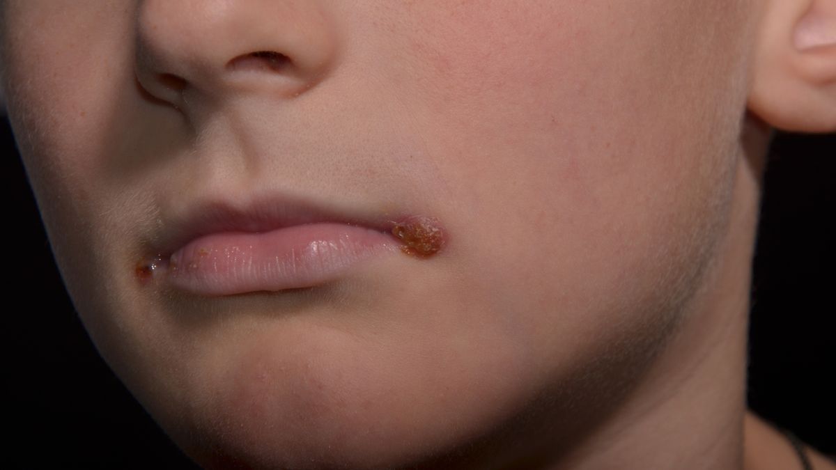 Zajady bardzo często pojawiają się u osób zmęczonych, źle odżywiających się i zestresowanych, dlatego warto stosować dietę bogatą w witaminy z grupy B oraz wprowadzić produkty stymulujące układ odpornościowy.