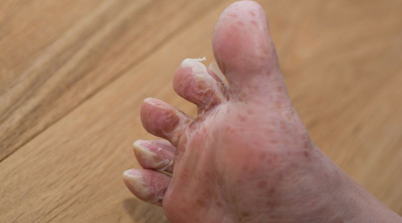 Choroba dłoni, stóp i jamy ustnej (HFMD)