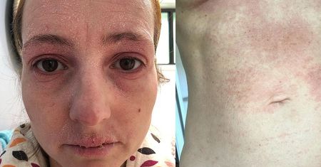 Młoda mama nie mogła się kąpać przez rok. Powodem była dziwna alergia na sterydy