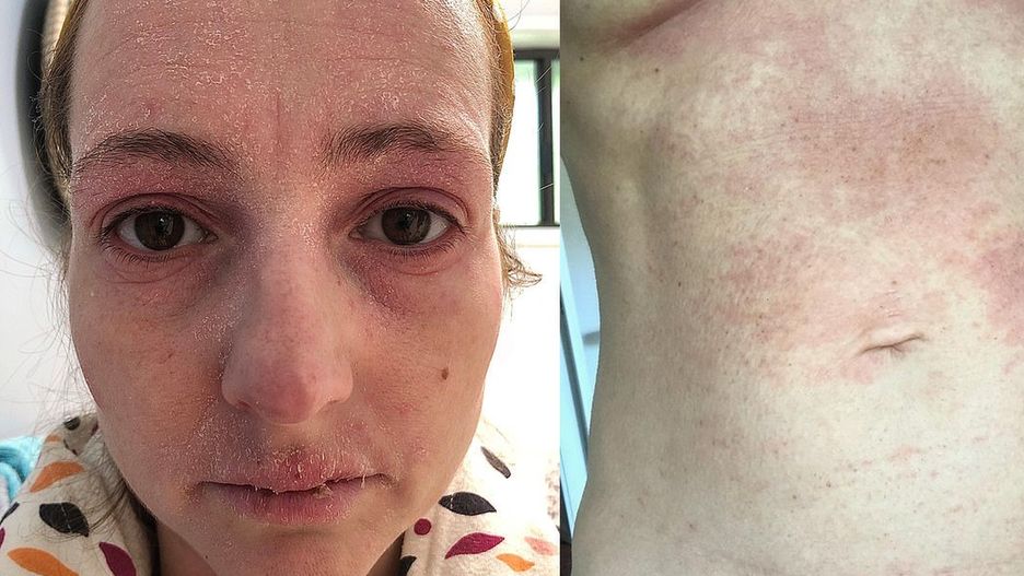 Dziwna wysypka po maści steryowej