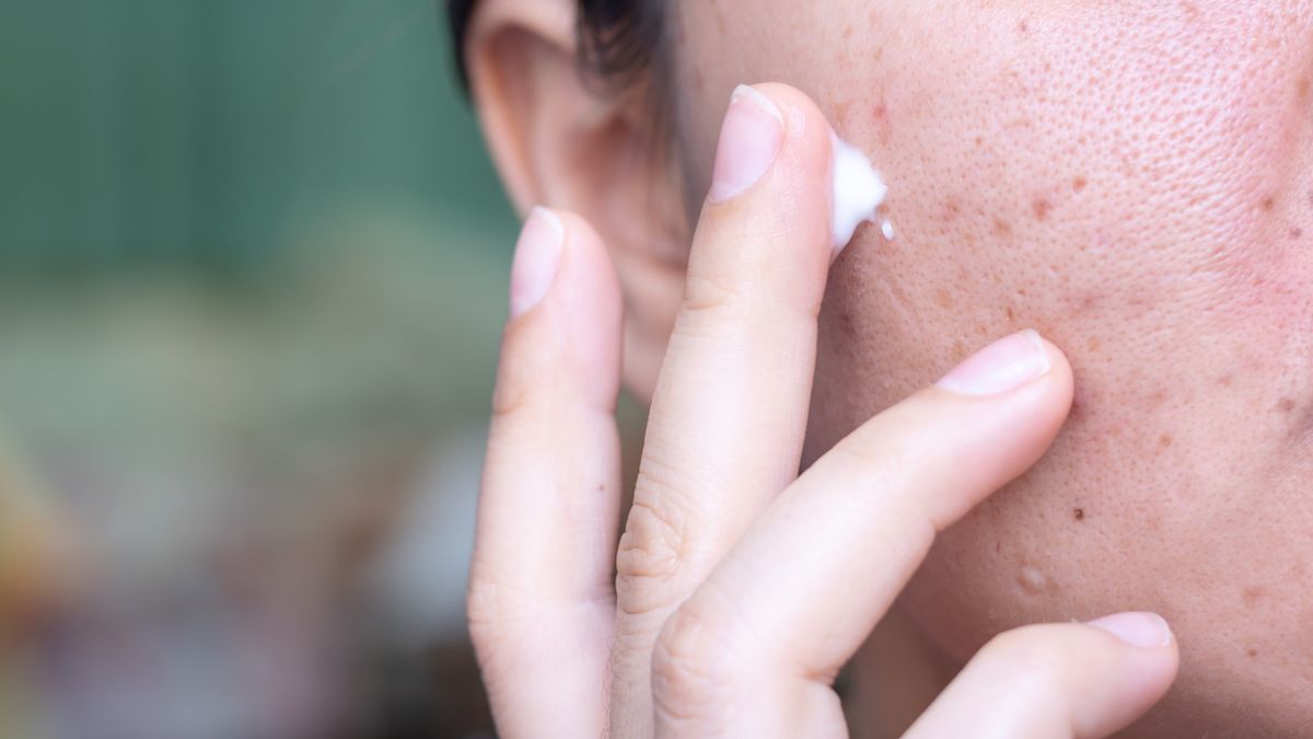 Krem na trądzik nie może być tłusty