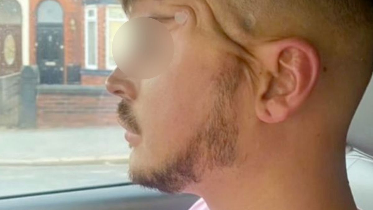 lisie oczy kocie oczy zabieg medycyna estetyczna