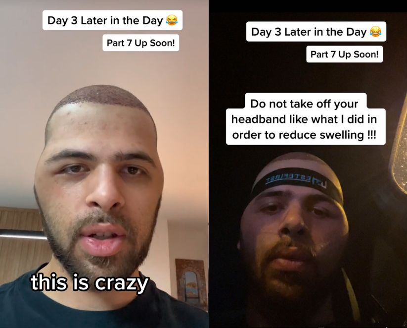 Przeszczepił włosy w Turcji. Oto jego historia