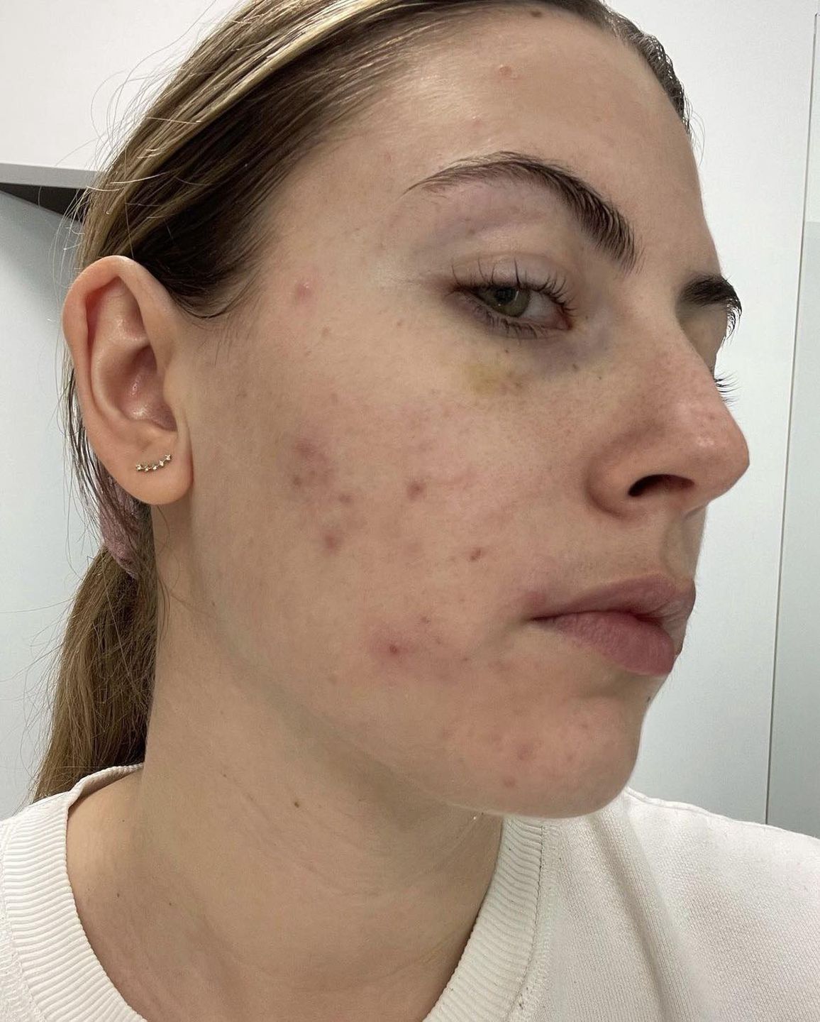 Aleksandra Grysz z "PnŚ" przez chorobę borykała się z poważnymi problemami skórnymi