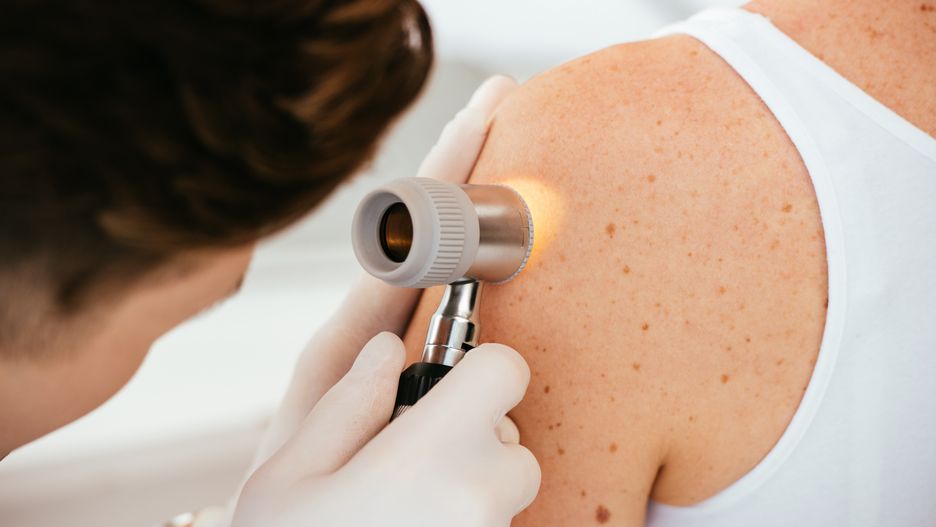 dermatolog, rak, czerniak