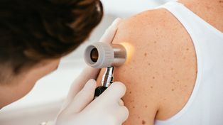 Łatwiejszy dostęp do leczenia czerniaka. Dwie nowe placówki w Łódzkiem